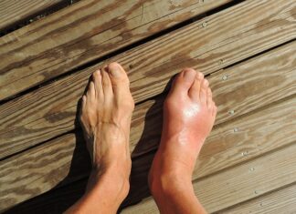 Czy wkładki wyleczą płaskostopie? Czy wkładki wyleczą płaskostopie?